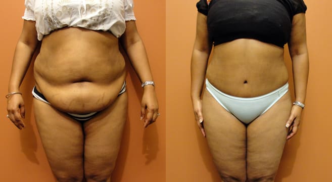 A abdominoplastia como método para eliminar o excesso de gordura